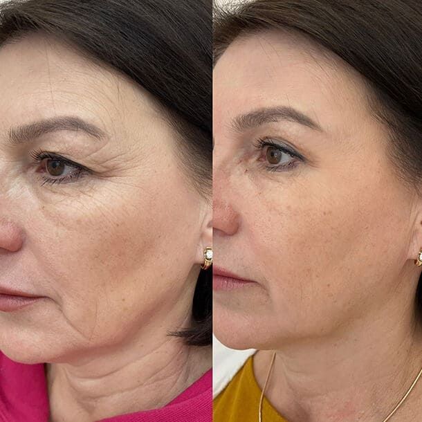 Reduce Fine Lines 60 ml Pack of 2